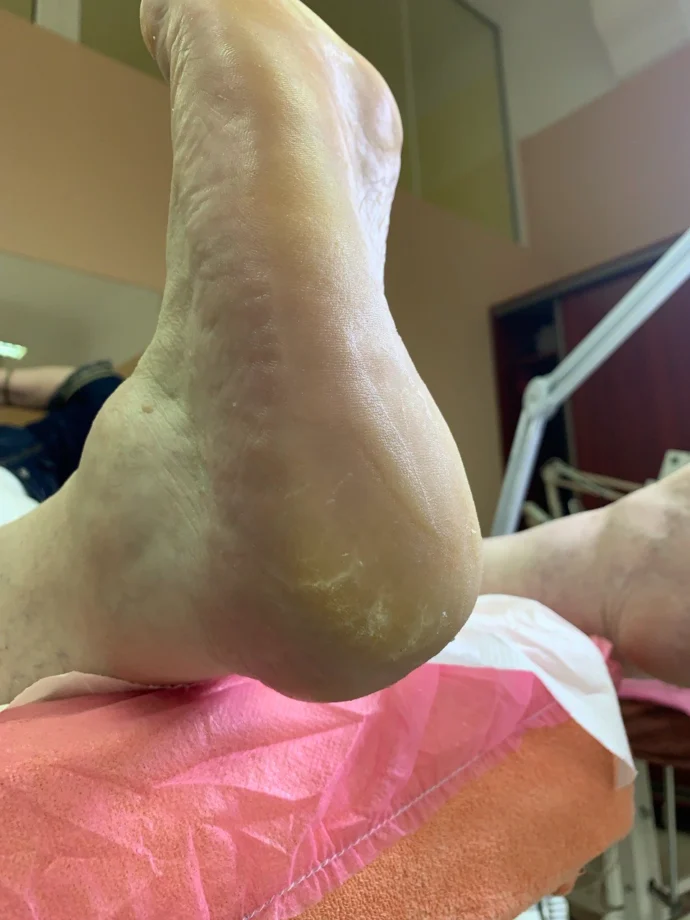Pedicure leczniczy Warszawa – Лікувальний педикюр– Лечебный педикюр