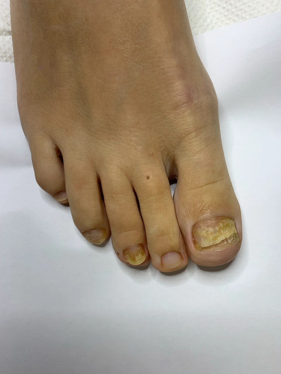 Leczenie onycholizy paznokci Warszawa