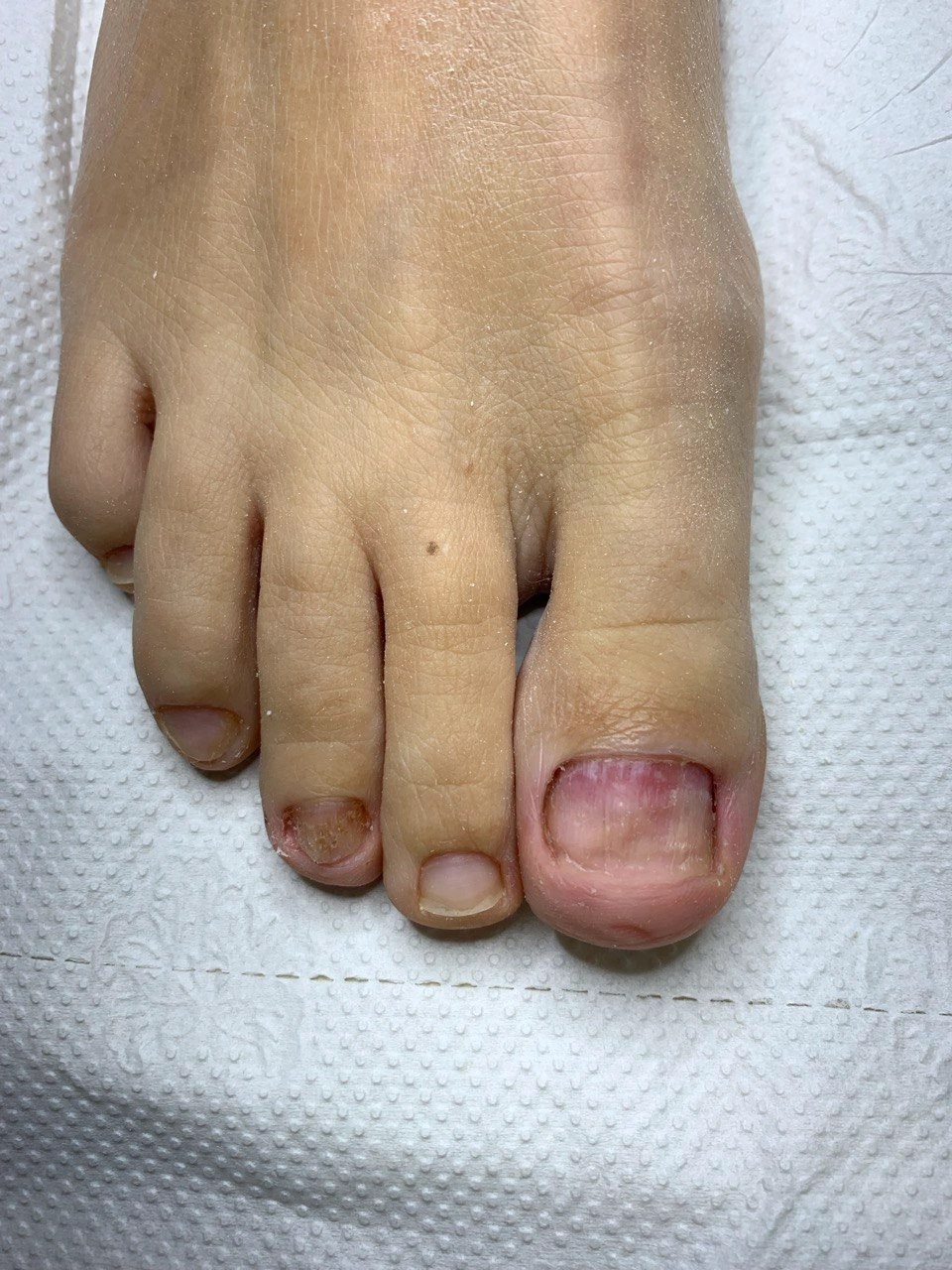 Leczenie onycholizy paznokci Warszawa